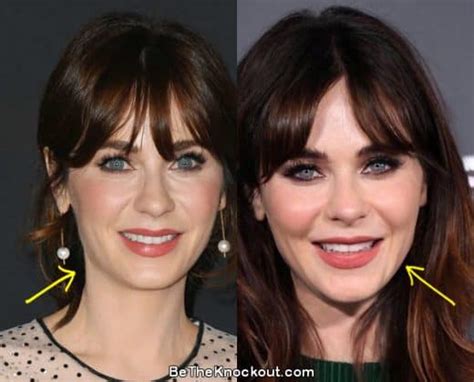 zooey deschanel plastic surgery